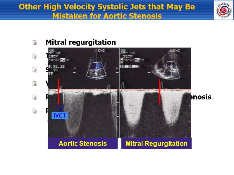 Other High Velocity Systolic Jets that May Be Mistaken for Aortic Stenosis  
